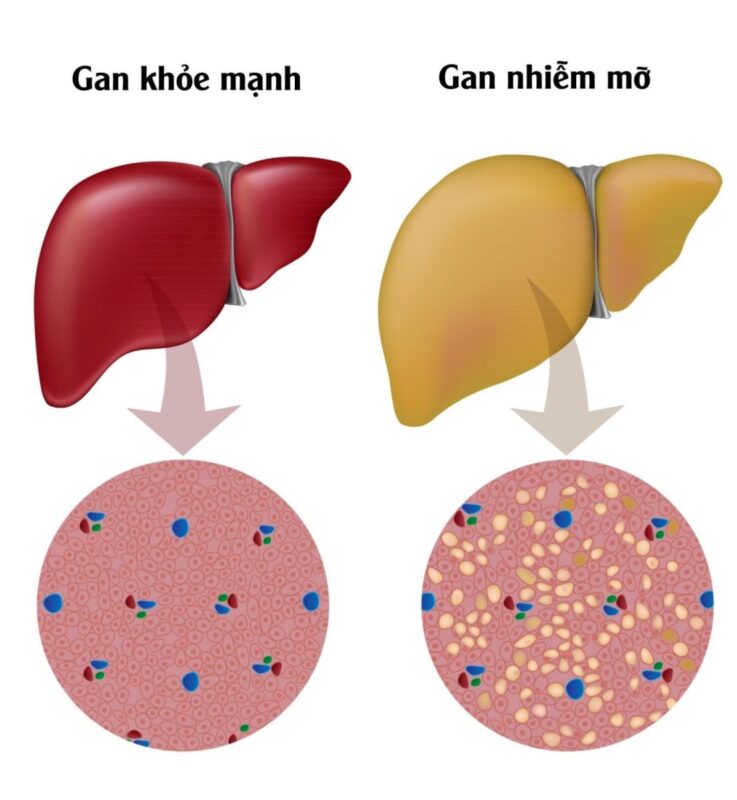 Gan nhiễm mỡ